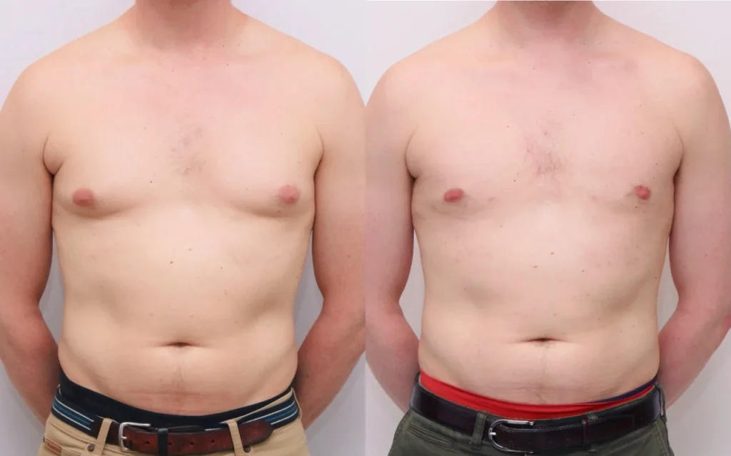 Gynecomastia in Bodybuilders - Causes, Prevention & Treatment