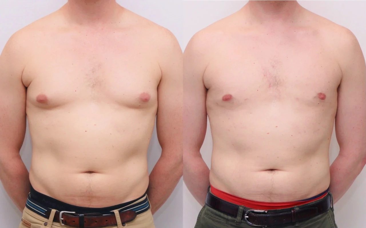 Gynecomastia in Bodybuilders - Causes, Prevention & Treatment
