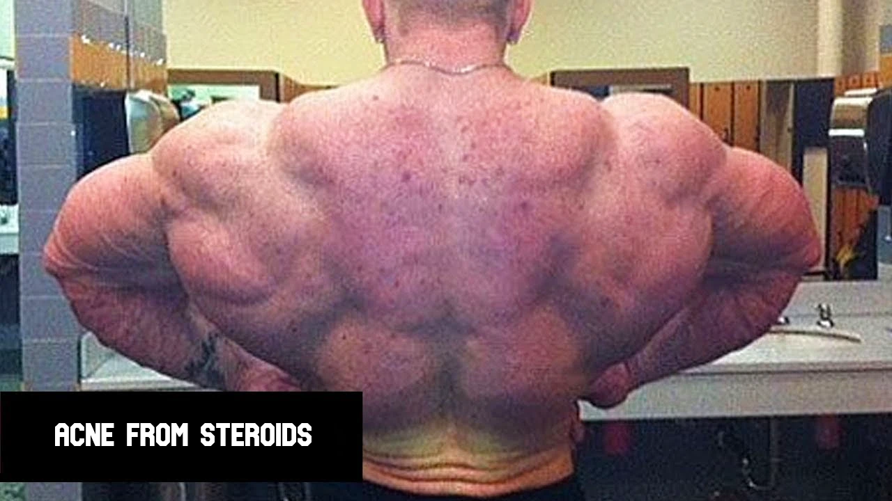 Why Steroids Cause Acne & How to Fix It Fast (Backed by Science)